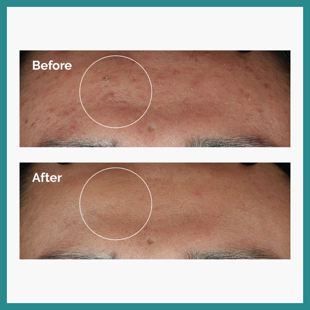 The Ordinary Niacinamide 10% + Zinc 1% – Pureté, équilibre et éclat pour votre peau